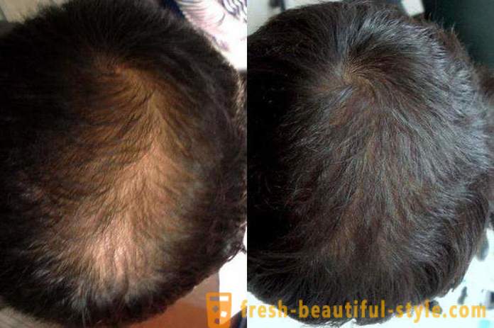 Vaistai, kurių minoksidilas plaukams: apžvalgos, funkcijos ir aprašymas geriausias taikymo