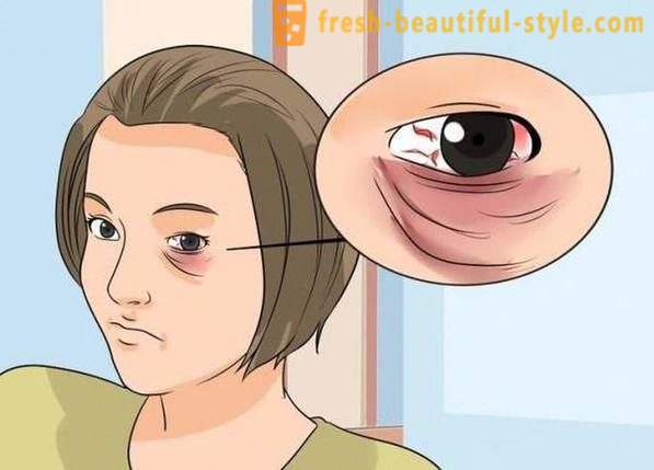 Kaip paslėpti juodas akis nuo smūgio: kosmetika, ypač rekomendacijos ir