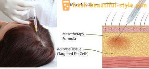 Mezoterapija plaukų makiažas įrankių ir kontraindikacijos