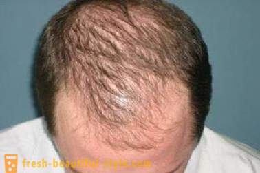 Kaip pagreitinti plaukų augimą ant galvos? Restauravimas plaukų augimą