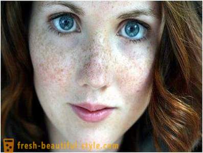 Rūpinkitės savo grožiu ir jaunimo: sukelia pigmentaciją ant veido